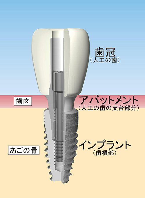歯科用インプラント｜一般の皆様・患者様｜KENTEC